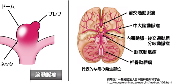 U-info｜未破裂脳動脈瘤とはなんでしょう？